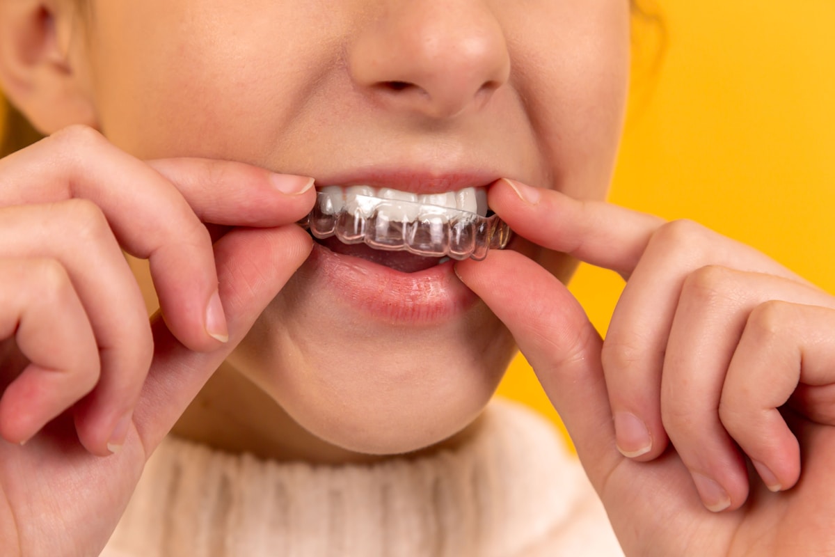 Clear aligner treatment at Supreme Elite Clinic